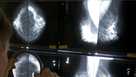 Radiologist checks for breast cancer