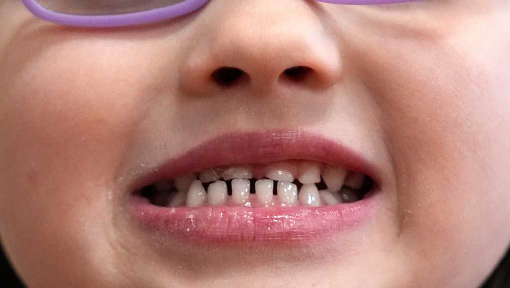 FDA Restricts Fluoride Supplements for Children Amid Safety Concerns