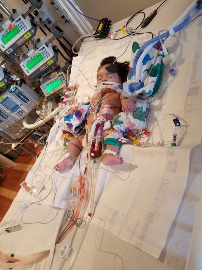 Sacramento newborn survives rare heart transplant