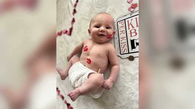 3-month-old has lifesaving surgery at Johns Hopkins - Vimarsana News