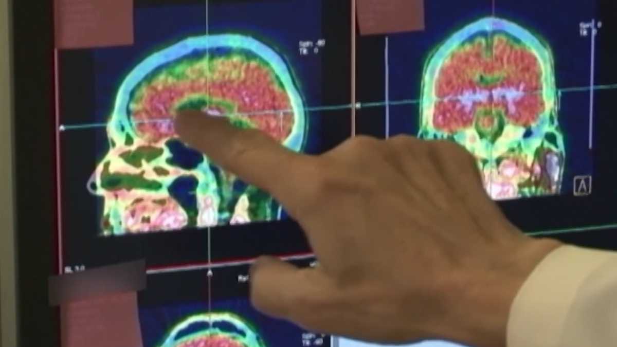 Study at Kennedy Krieger reviews effects of concussions on kids