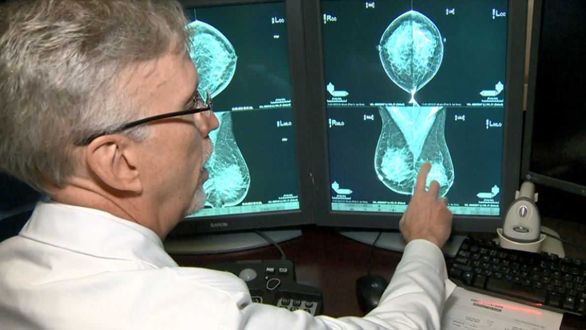 Sutter Health works to detect breast cancer with blood test