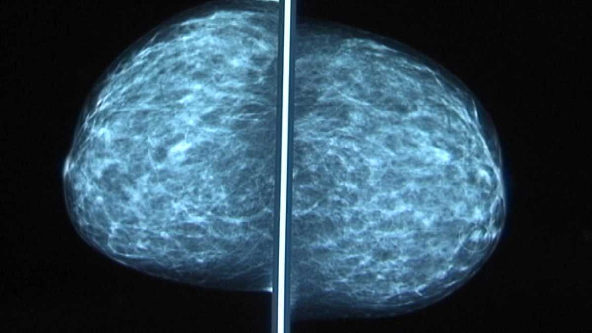 Triple-negative breast cancer is treatable, if caught early