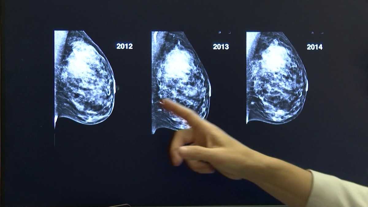Density is an important factor for breast cancer