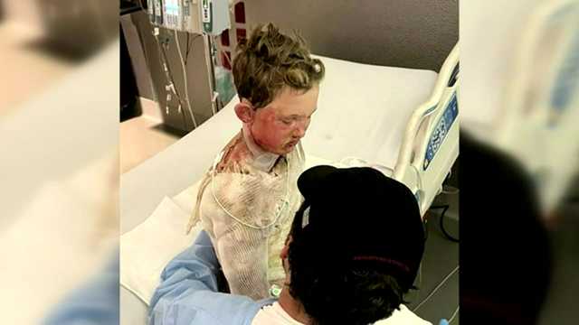 Georgia: Boy suffers burns over half his body from experiment - Vimarsana News