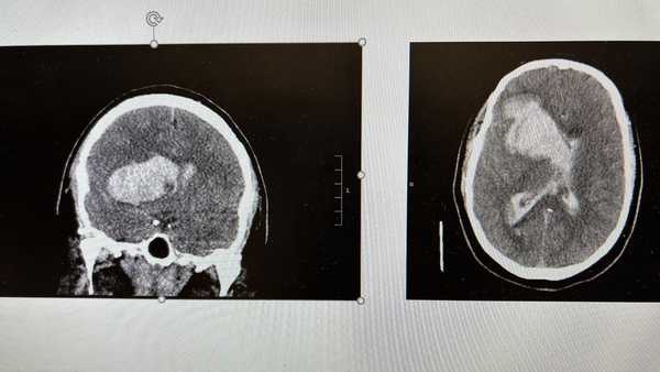 casey brewer stroke ct scan