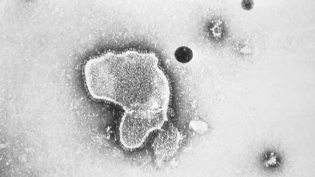 CDC: RSV cases may be starting to rise - Vimarsana News