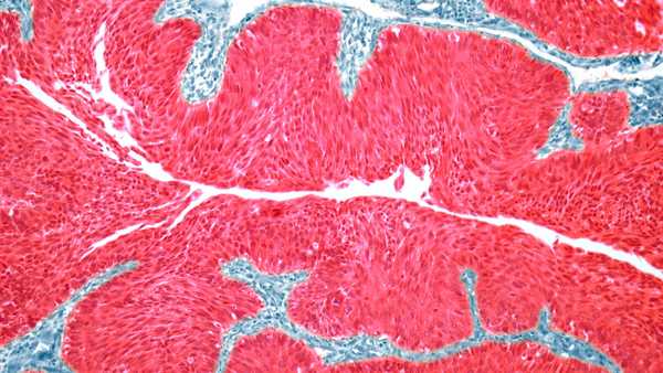 A light micrograph image of a section through a transitional cell carcinoma of the bladder wall. A new combination of cancer medications has been shown in research to extend overall survival in patients with advanced bladder cancer.