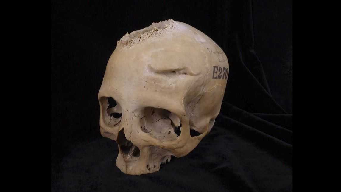 Evidence of surgical tumor removal in ancient Egyptian skull - Vimarsana News