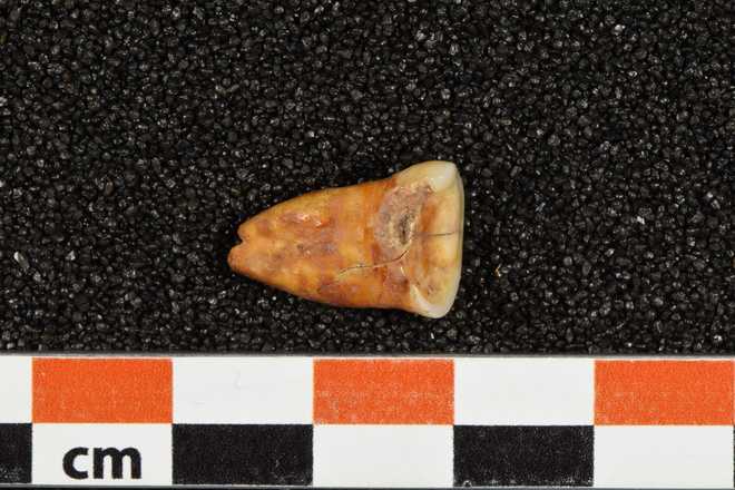 A&#x20;human&#x20;tooth&#x20;unearthed&#x20;from&#x20;Taforalt&#x20;Cave&#x20;in&#x20;Morocco&#x20;shows&#x20;severe&#x20;wear&#x20;and&#x20;caries,&#x20;or&#x20;cavities.