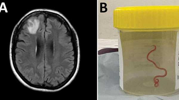 The worm specimen was extracted alive from the woman's brain by surgeons at Canberra Hospital in Australia.