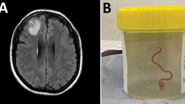 Doctors remove parasitic worm from woman's brain in world first - Vimarsana News