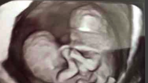 Recently Born Conjoined Twins Head Home