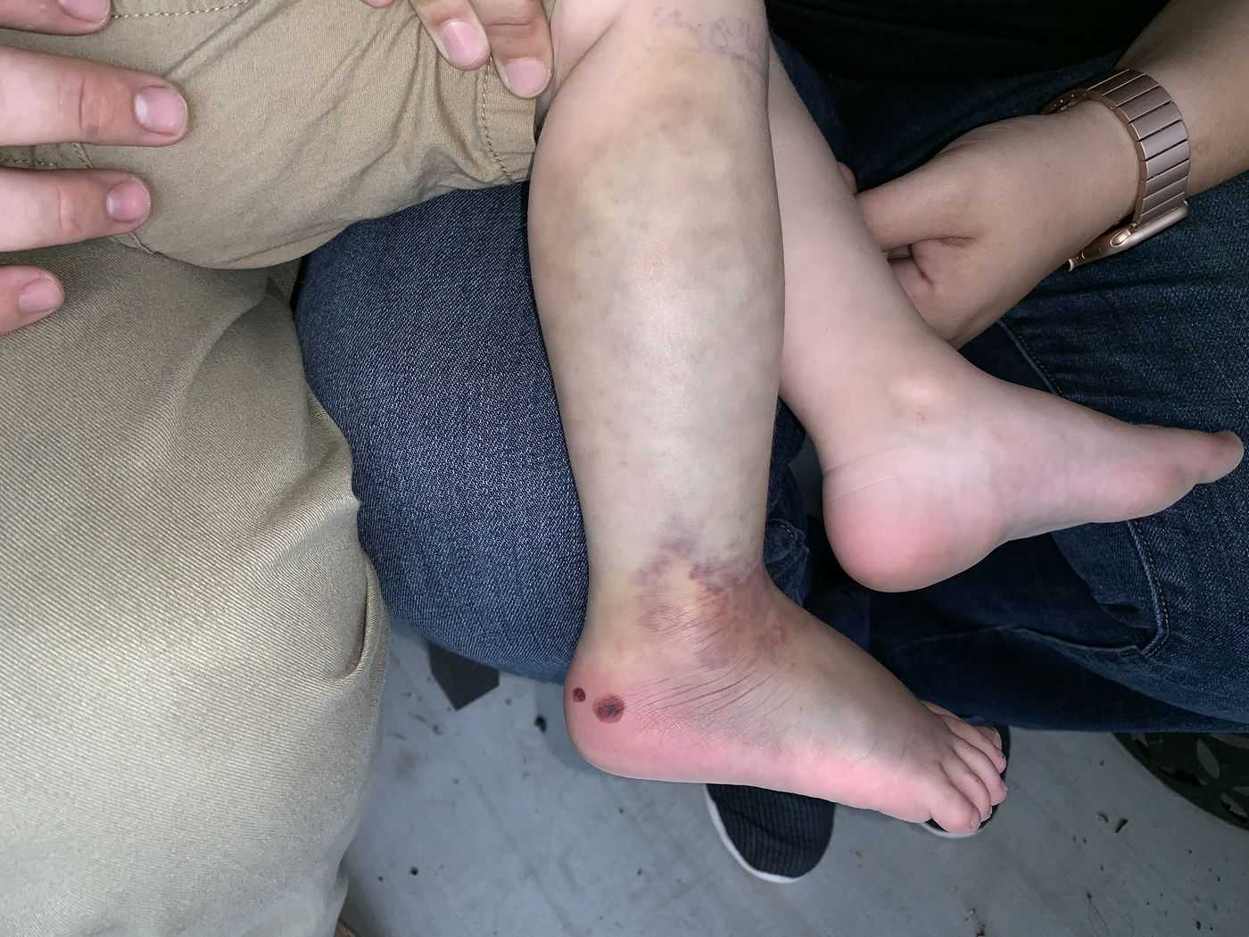 Worst Nightmare Horry County 2 Year Old Suffers Copperhead Snake Bite