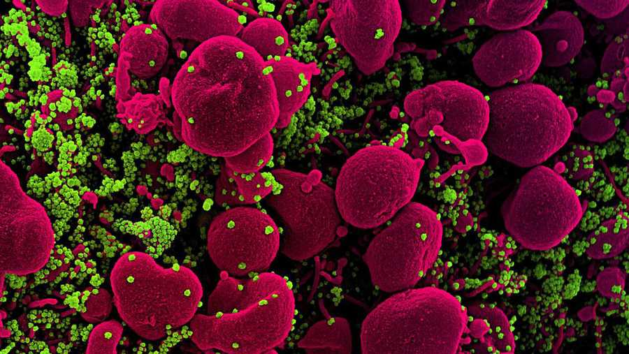 Colorized scanning electron micrograph of an apoptotic cell (pink) heavily infected with SARS-COV-2 virus particles (green), isolated from a patient sample. Image captured at the NIAID Integrated Research Facility (IRF) in Fort Detrick, Maryland.