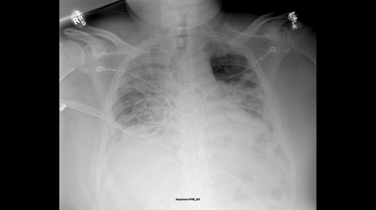 Lung xrays show difference vaccine can make for people infected with