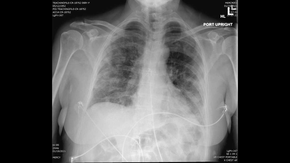 Xrays, scans show COVID19’s ‘frightening’ effects on Maine patients