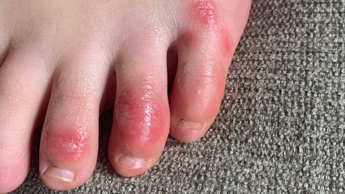 Covid Toes Other Rashes Latest Possible Rare Coronavirus Signs Covid Toes Other Rashes Latest Possible Rare Coronavirus Signs