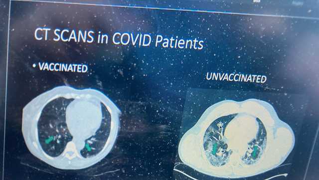Images show effects of lung damage among unvaccinated people - Vimarsana News