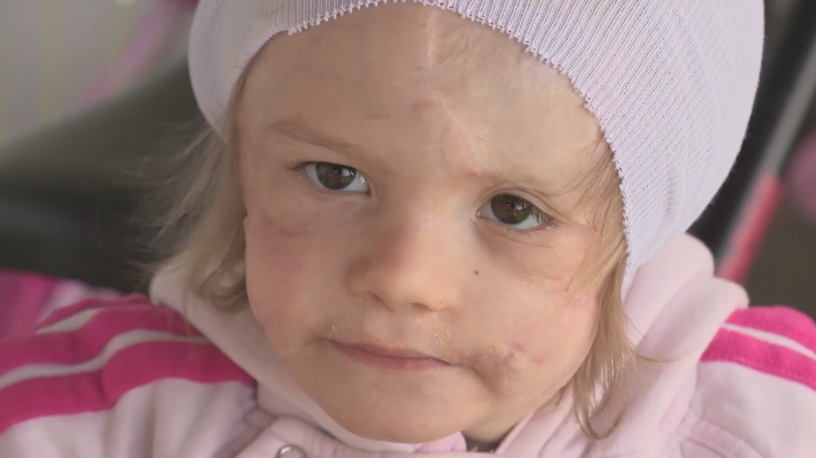 3-year-old girl who survived gruesome dog attack needs prosthetic ears - Vimarsana News