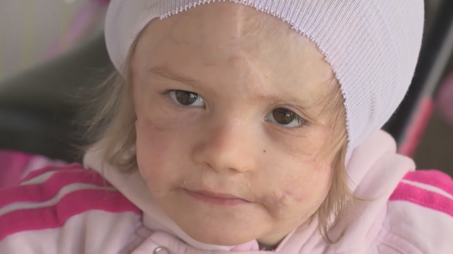 3-year-old girl who survived gruesome dog attack needs prosthetic ears - Vimarsana News