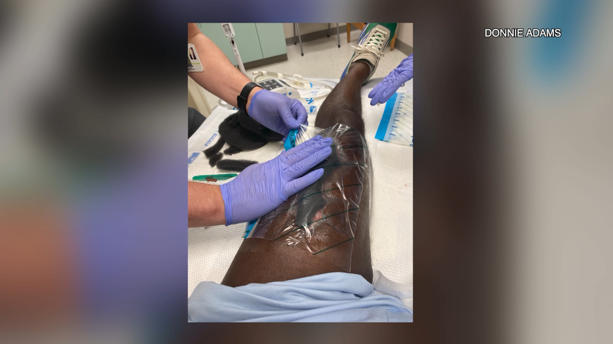 Florida Man’s Bite Wounds with Flesh-eating Bacteria