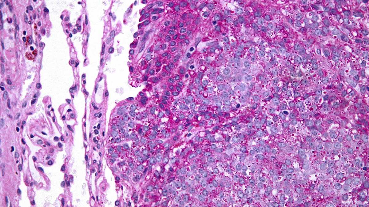 State Department of Health finds no cancer cluster around Canon-McMillan School District - WTAE Pittsburgh thumbnail