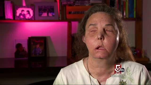 Faces: Facial Transplant