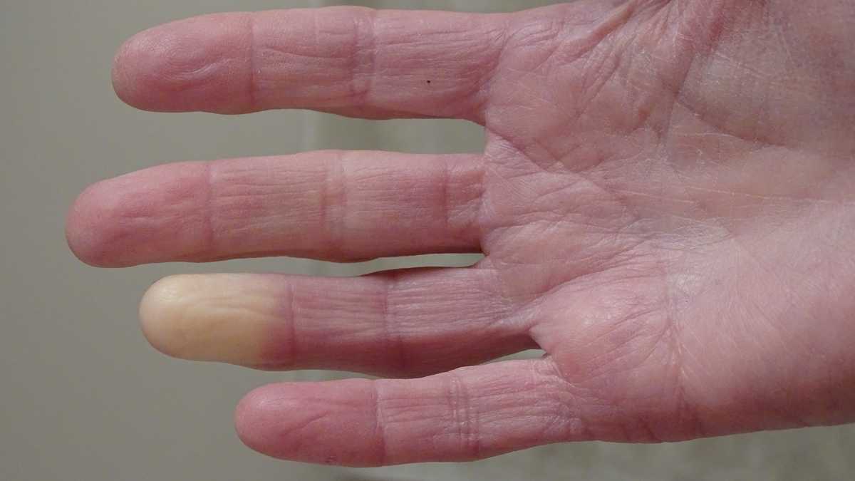 Cold Foreceps Doctor explains causes of cold hands, when to seek care