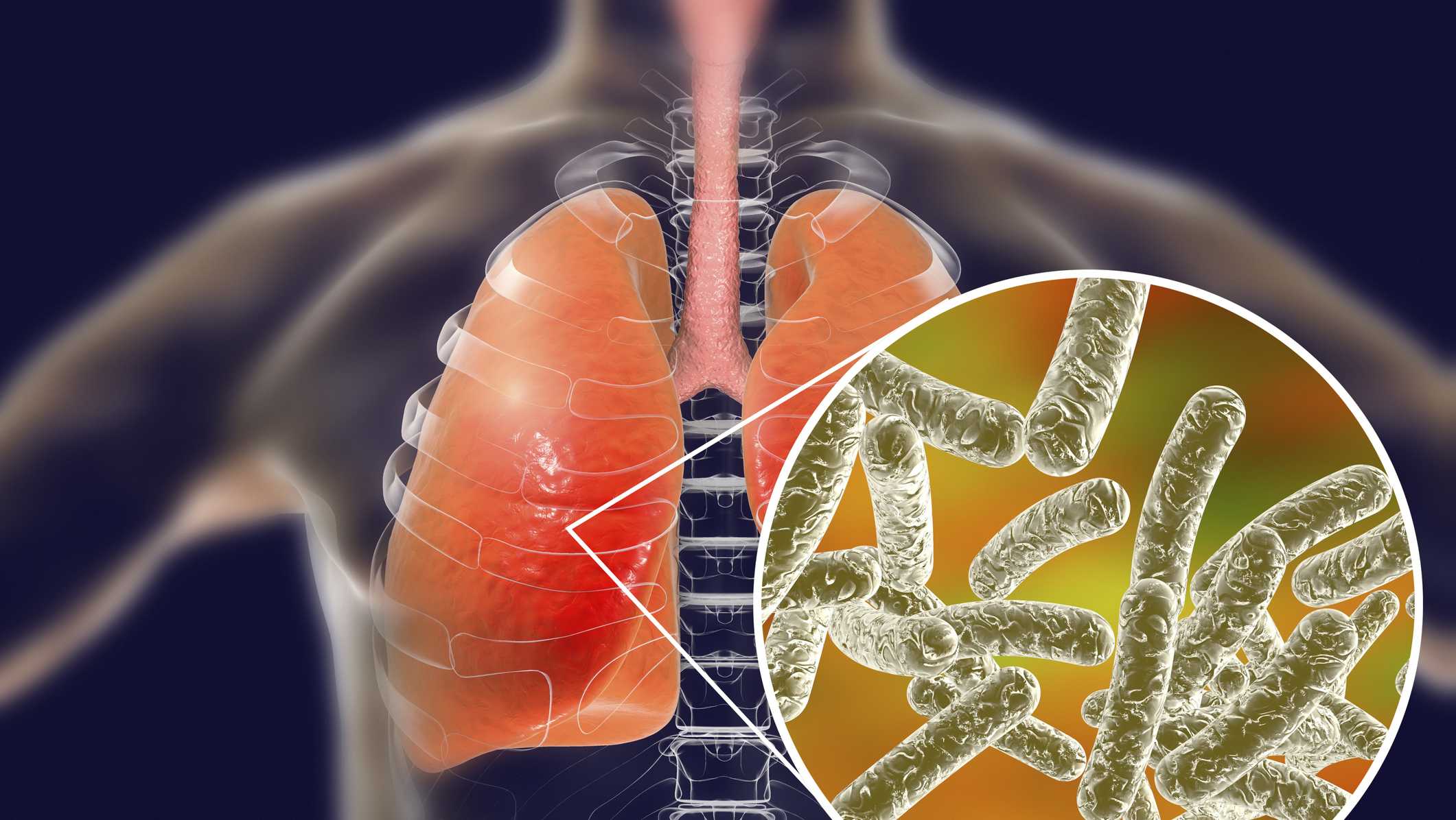 What people should know about Legionnaires’ disease
