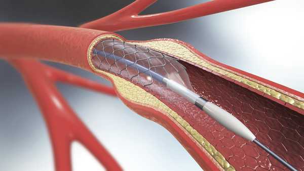 Arterial stent, illustration.