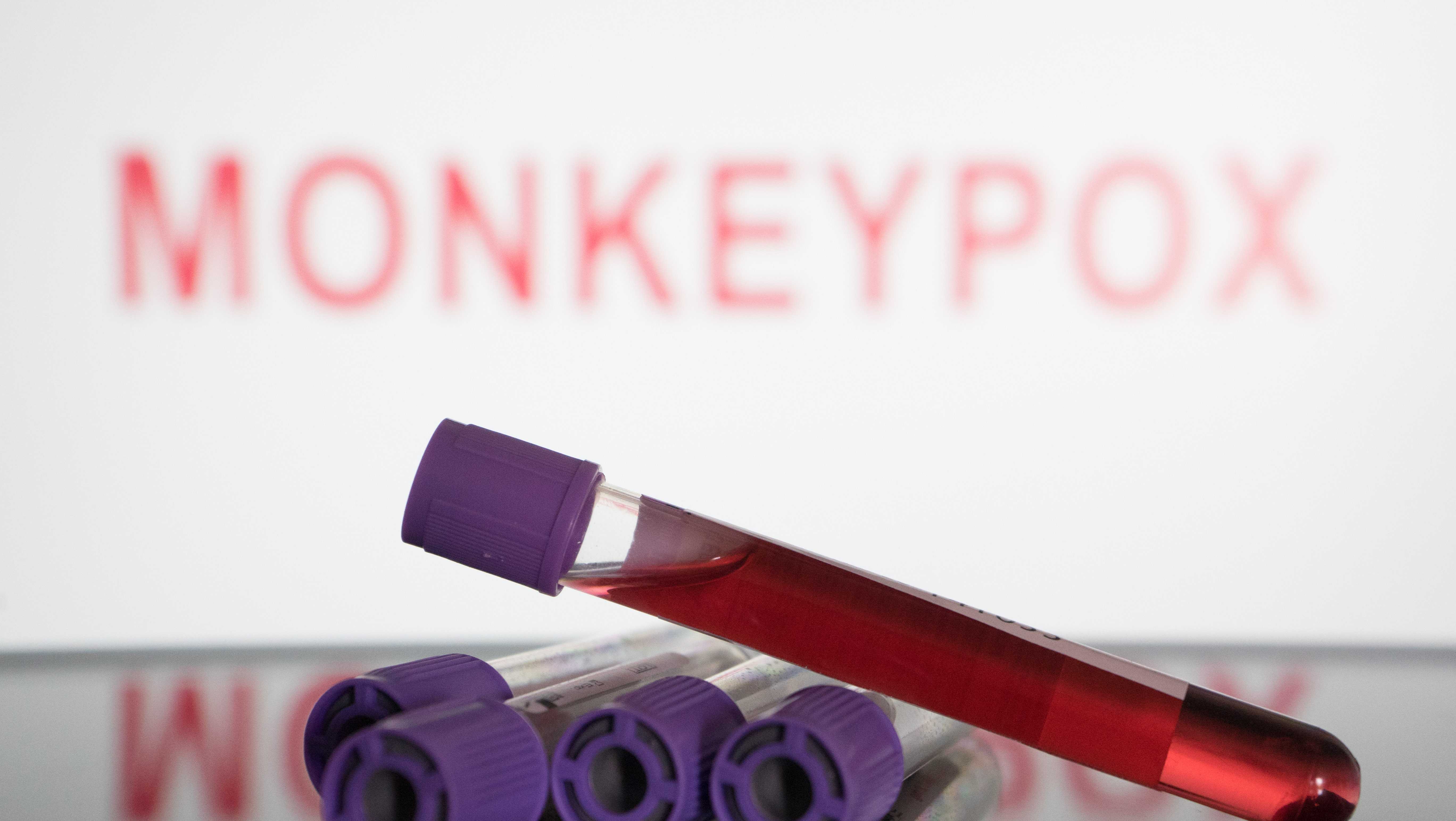 UN health agency chief declares monkeypox a global emergency - Vimarsana News