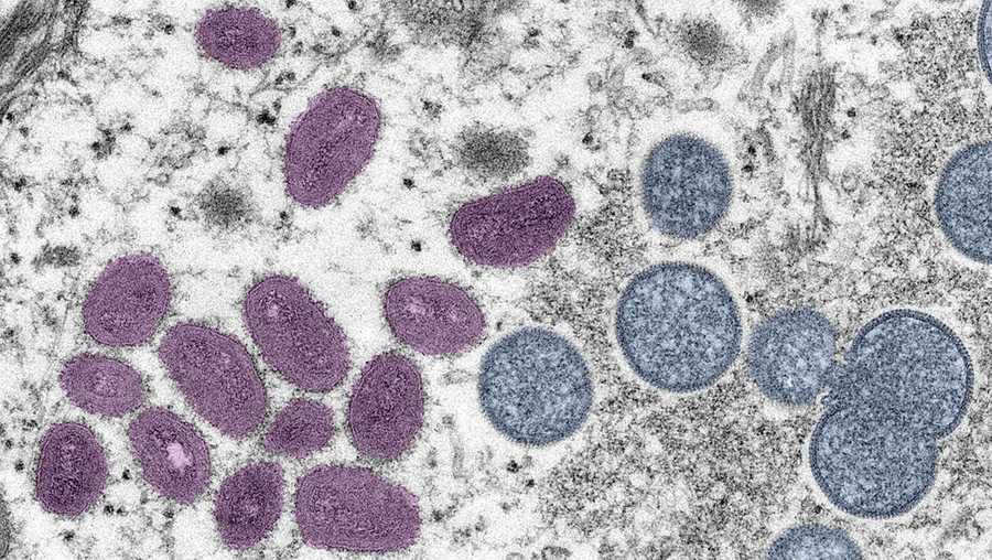 Digitally-colorized electron microscopic (EM) image depicting a monkeypox virion (virus particle), obtained from a clinical sample associated with a 2003 prairie dog outbreak, published June 6, 2022. The image depicts a thin section image from a human skin sample. On the left are mature, oval-shaped virus particles, and on the right are the crescents and spherical particles of immature virions. Courtesy CDC/Goldsmith at al. (Photo via Smith Collection/Gado/Getty Images)
