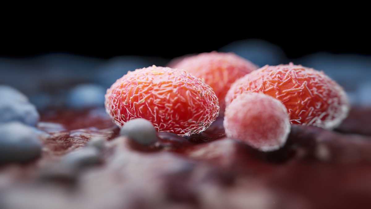 Monkeypox case confirmed in Lee County