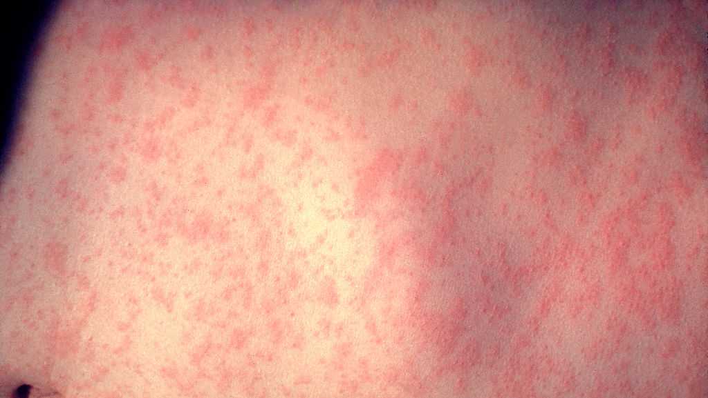 Kansas City health officials confirm first measles case in eight years