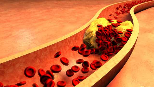 Here's what to watch for when it comes to high cholesterol - Vimarsana News