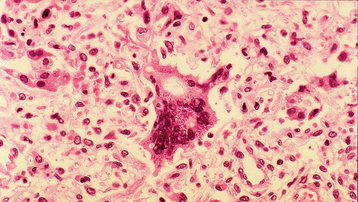 Ohio health officials report state’s first measles cases, outbreak of 2026