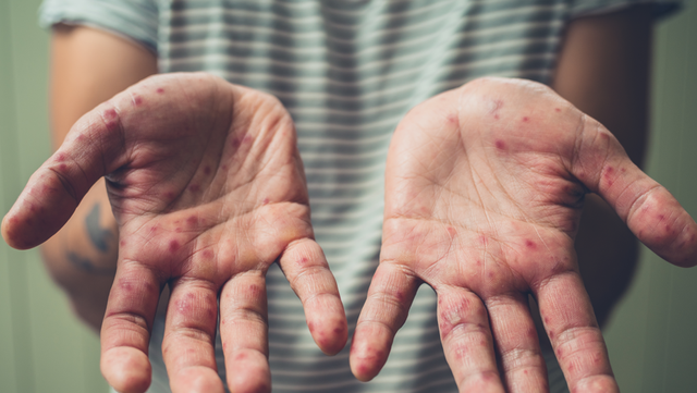 Loyola Hand Foot and Mouth disease on campus - Vimarsana News
