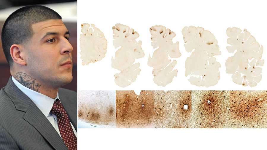 Aaron Hernandez and CTE brain image from BU CTE Study