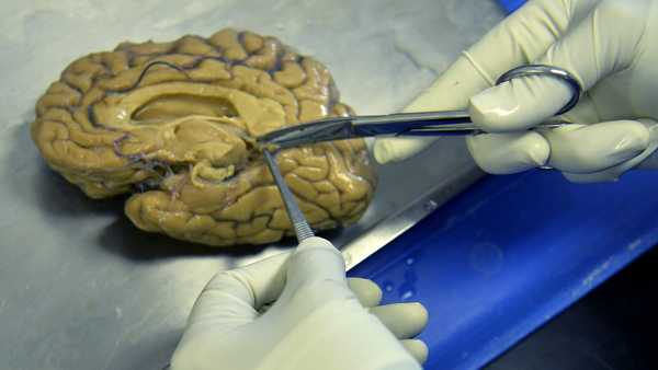 Antioquia University's Neurobanco coordinator, Colombian doctor Carlos Villegas (out of frame), dissects a brain section at the laboratory in Medellin, Antioquia department, Colombia on December 2, 2014. Neurobanco, the only brain bank in the country, is a mainstay for global research on brain diseases, with a donation of 234 brains stored at -80 °C, many of which belonged to Alzheimer patients.   AFP PHOTO/RAUL ARBOLEDA        (Photo credit should read RAUL ARBOLEDA/AFP via Getty Images)