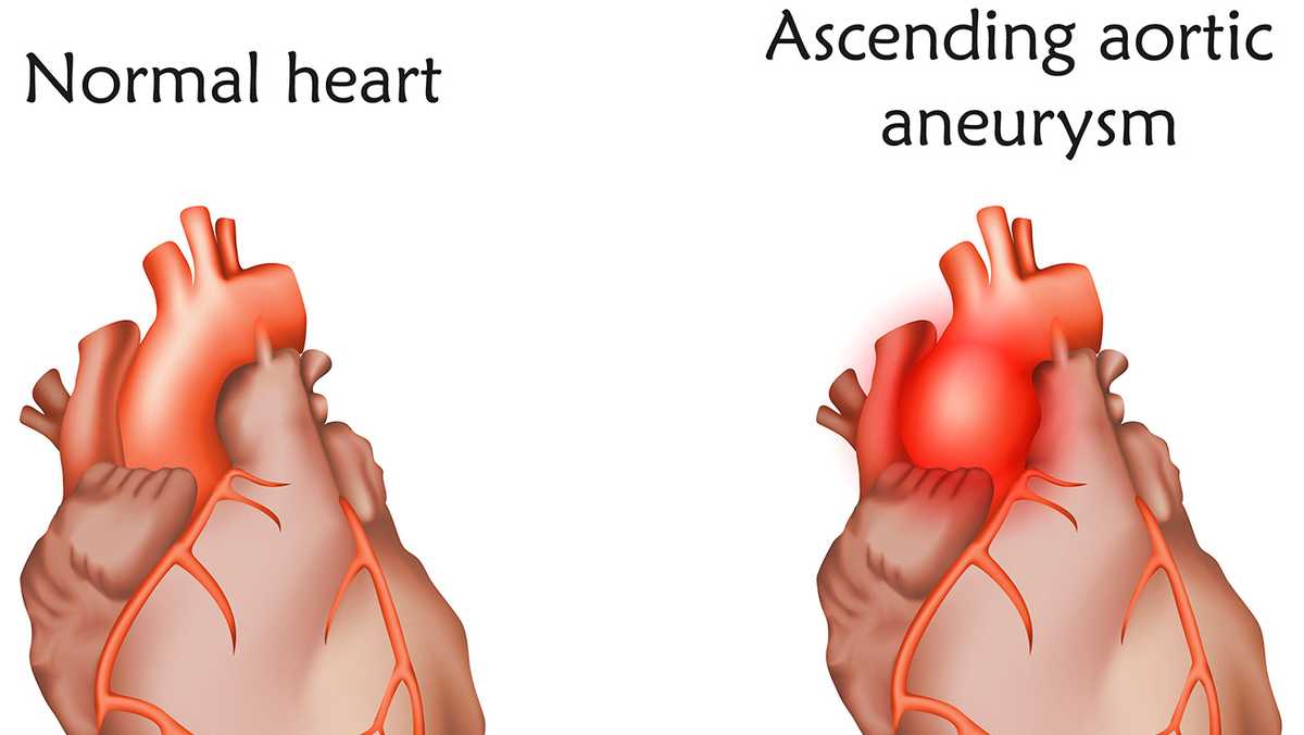 what-is-an-aortic-aneurysm