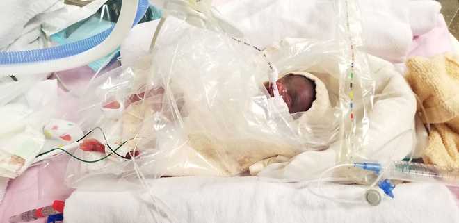 Siblings set record as the world's most premature twins