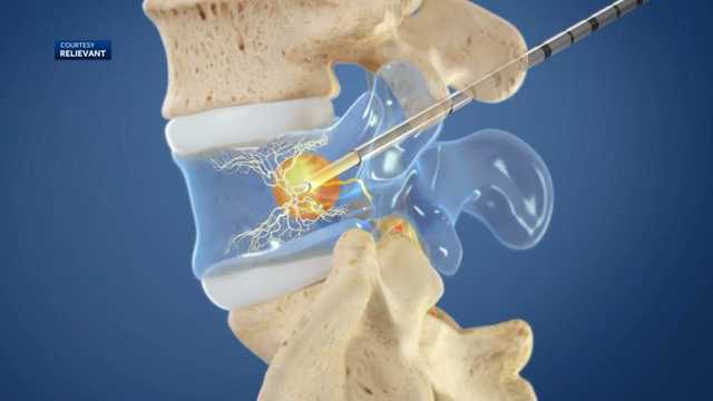 New, minimally invasive procedure in Baltimore treats back pain - Vimarsana News