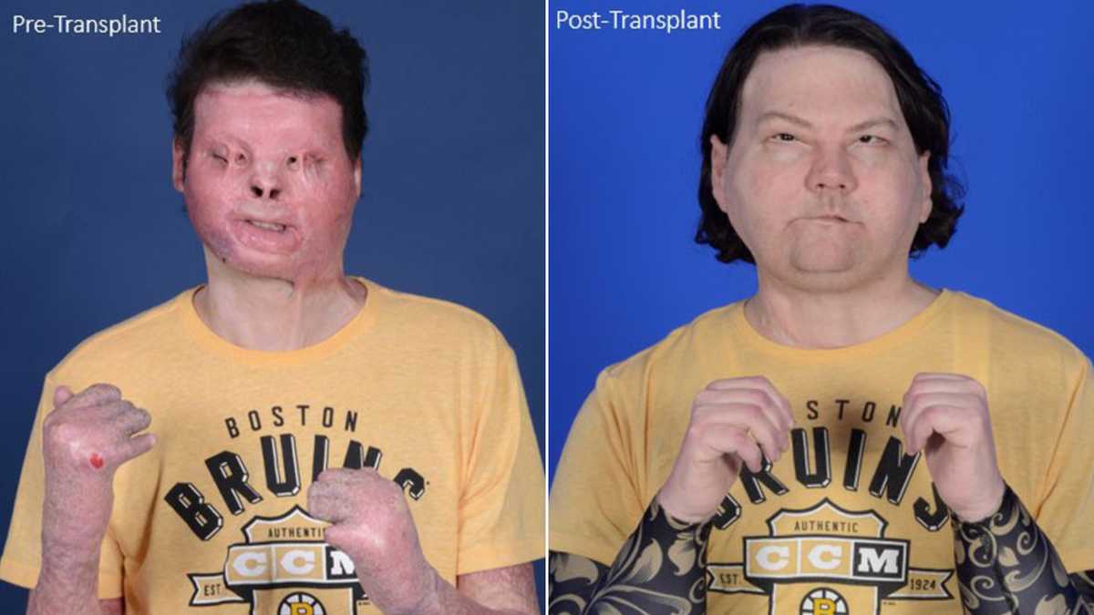 Worlds first face and hands transplant gives man a second chance at life