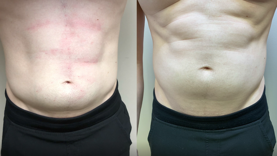 Local Doctor Uses Natural Enzyme To Break Down Fat Create Six Packs