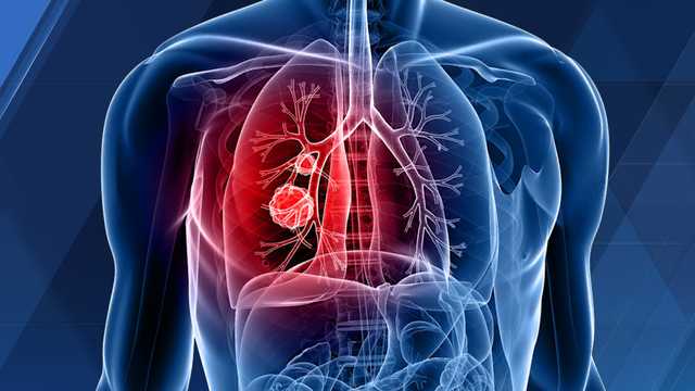 Local surgeons urge you get CT scan, as Kentucky once again leads nation with highest rate of lung cancer - Vimarsana News