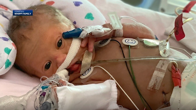 Children's hospital 'Miracle Maddie' discharged in time for Christmas - Vimarsana News