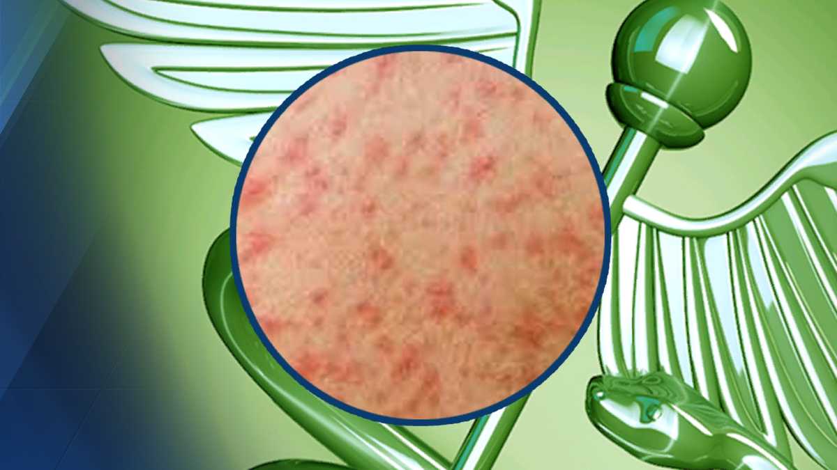 Confirmed case of measles in Milwaukee - WISN Milwaukee