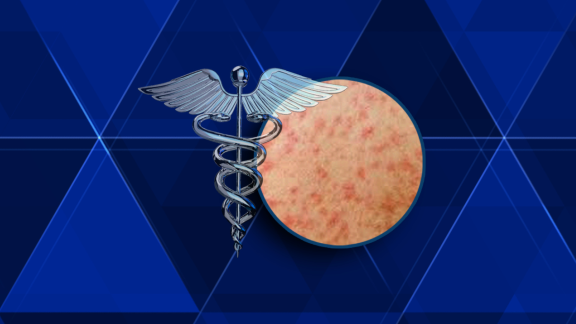 Second case of suspected measles, possible exposure in several locations in York county - WGAL Susquehanna Valley Pa. thumbnail