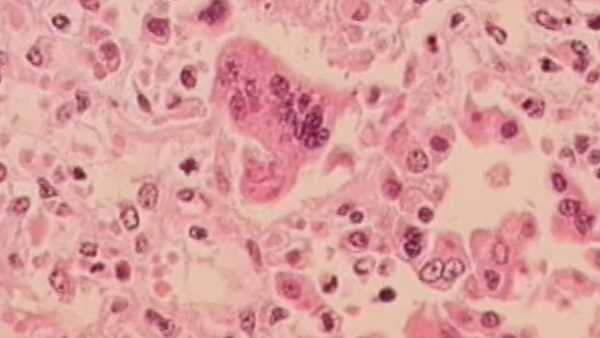Health Department investigating possible measles case in Cincinnati - WLWT Cincinnati thumbnail